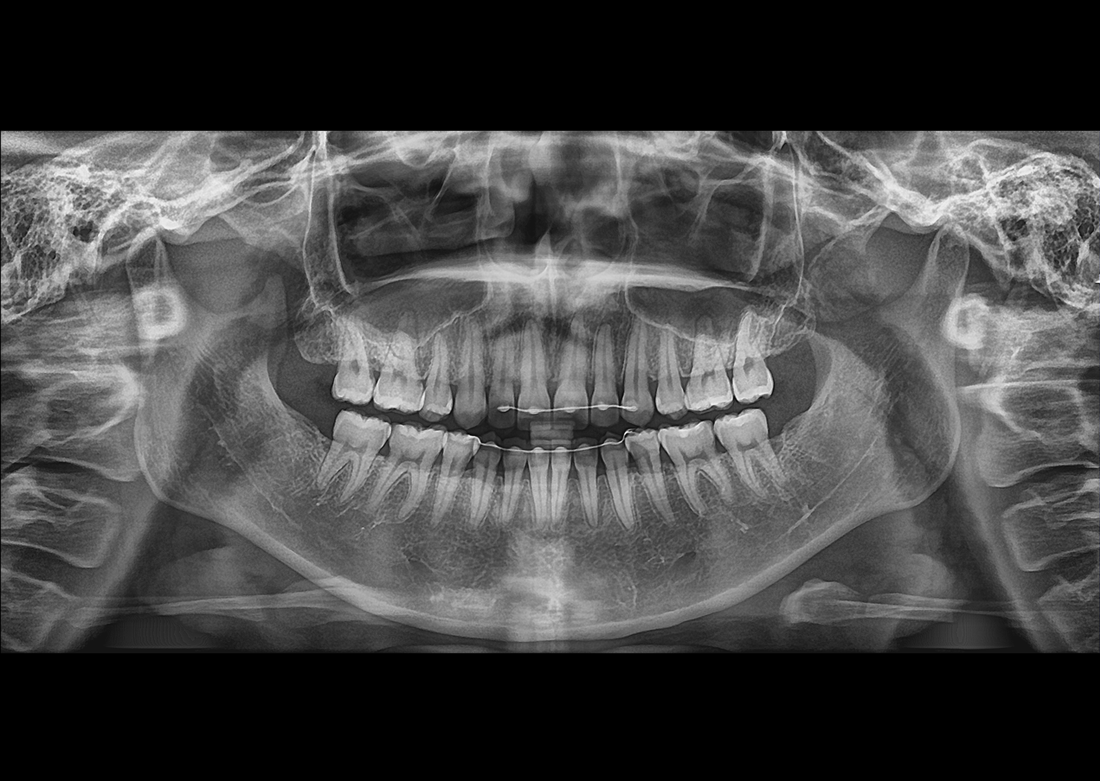 Genoray | Papaya 3D Premium/Ultra CBCT