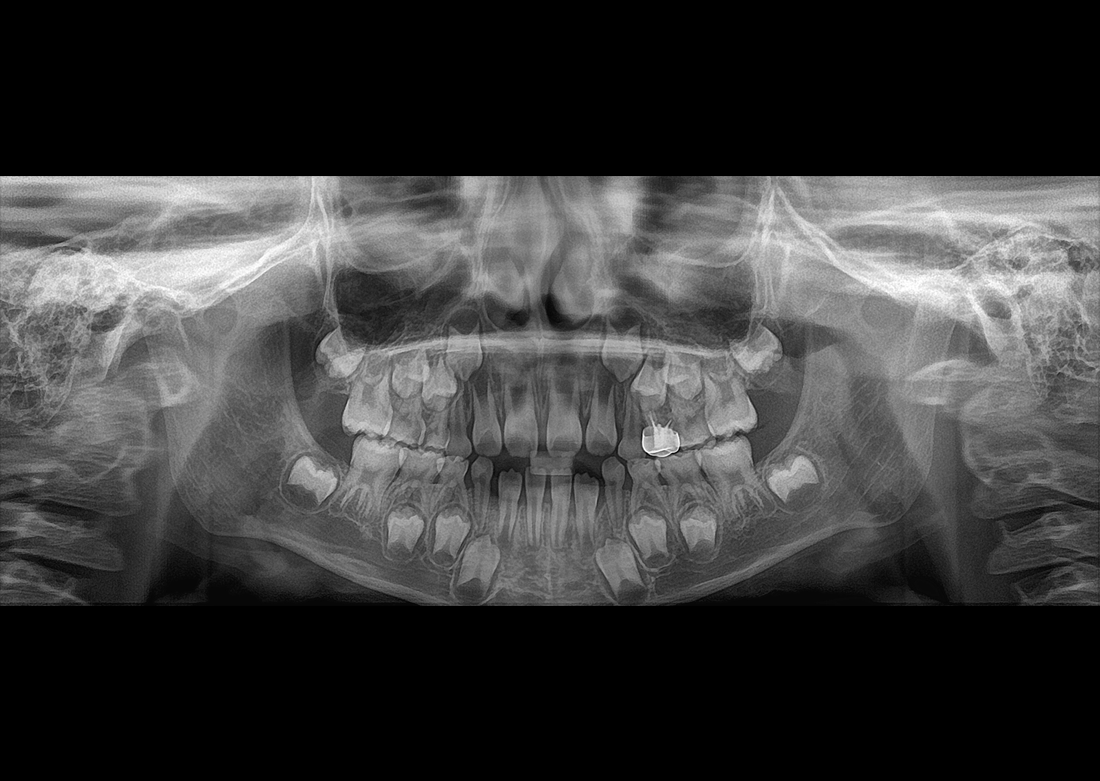 Genoray | Papaya 3D Premium/Ultra CBCT