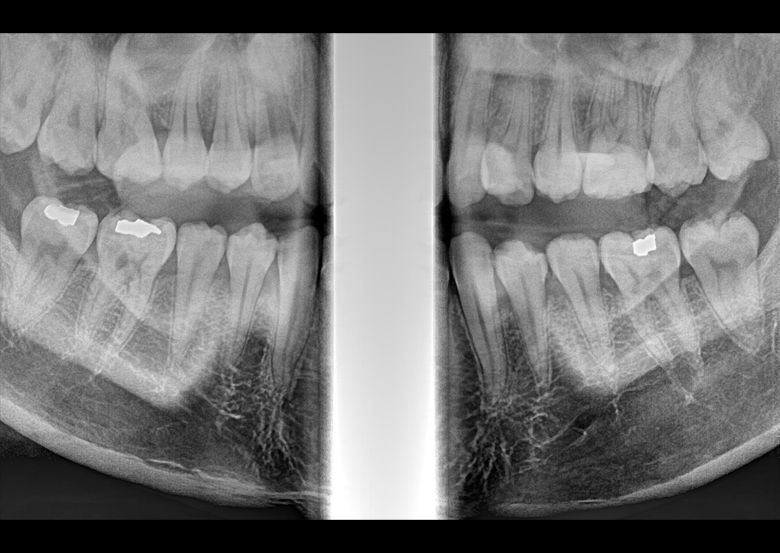 Genoray | Papaya 3D Premium/Ultra CBCT