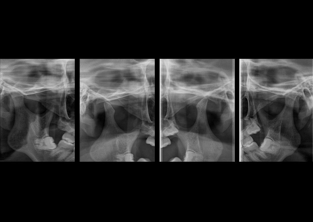 Genoray | Papaya 3D Lite CBCT
