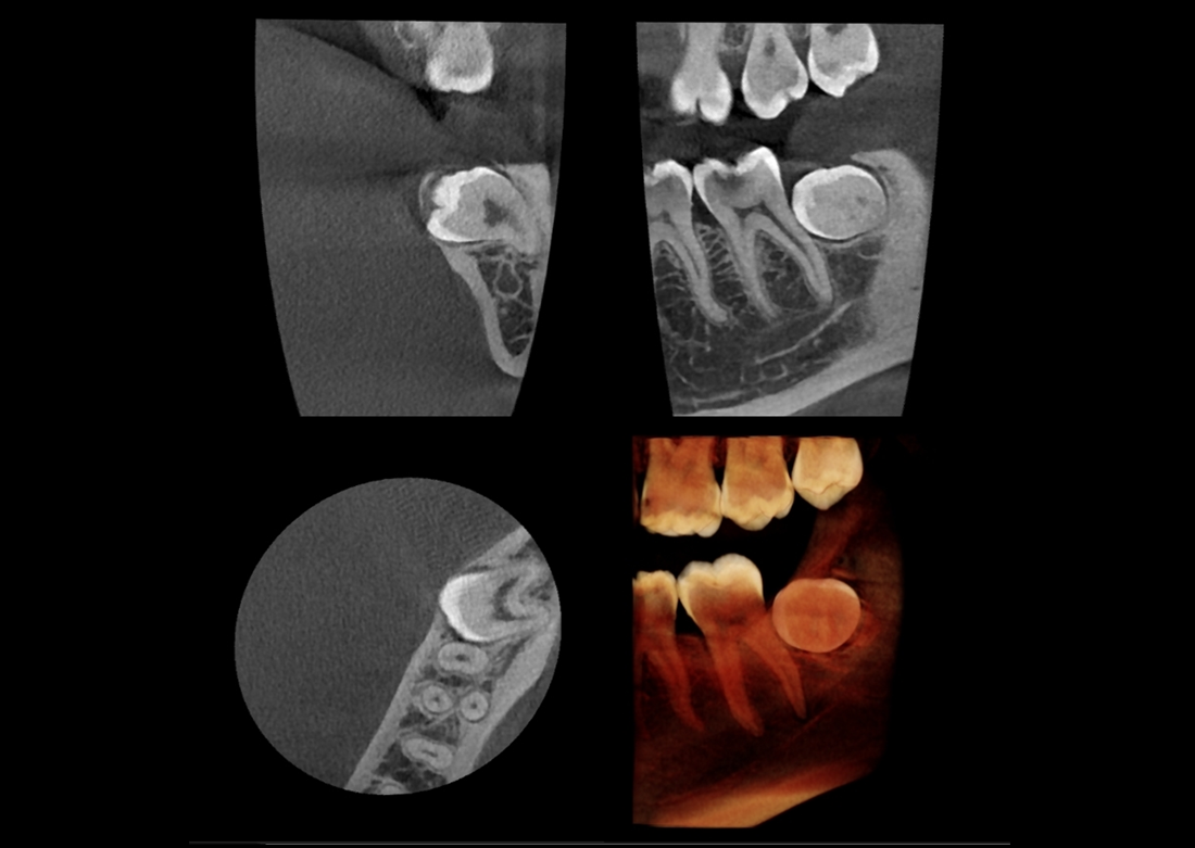 Genoray | Papaya 3D Premium/Ultra CBCT