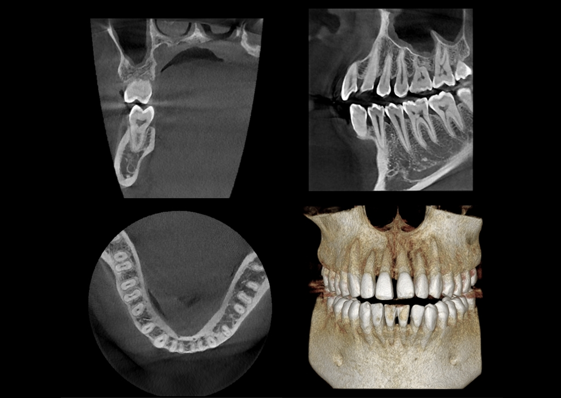 Genoray | Papaya 3D Premium/Ultra CBCT
