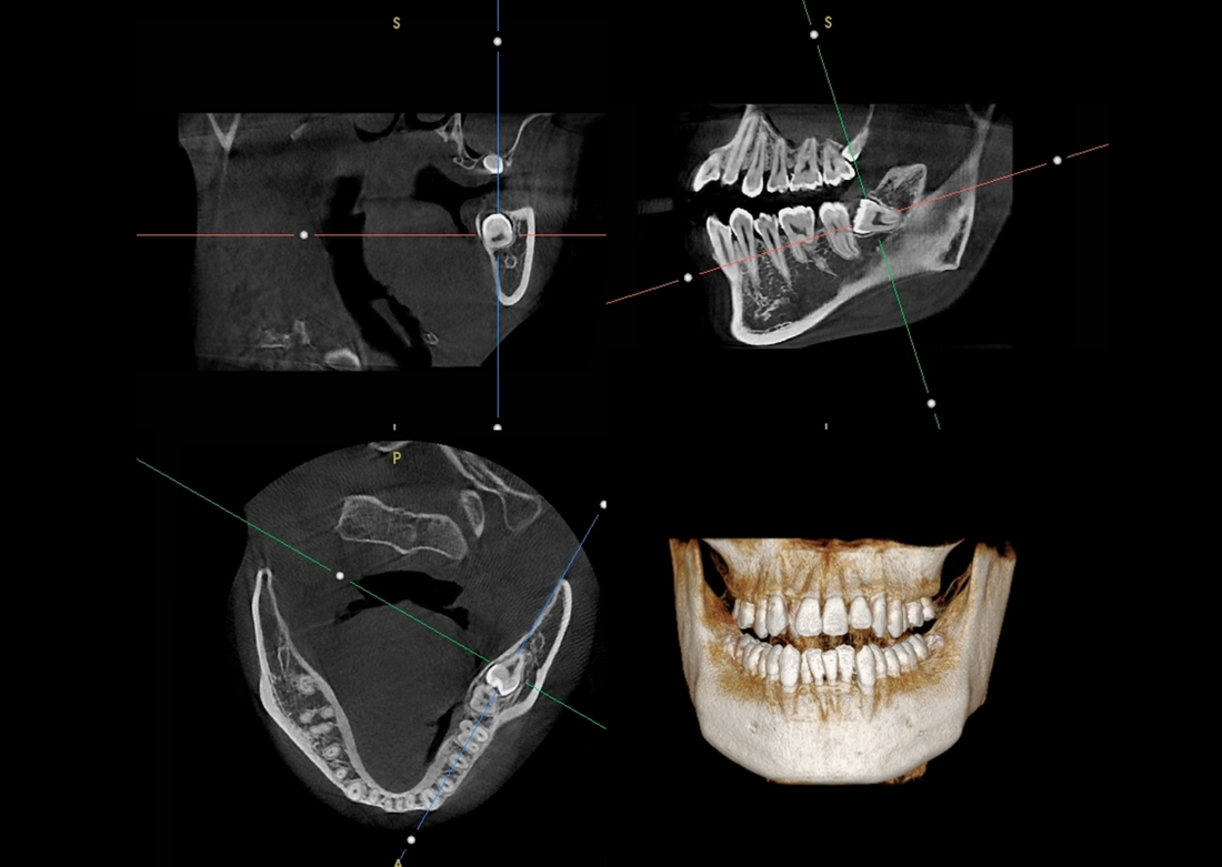 Genoray | Papaya 3D Premium/Ultra CBCT