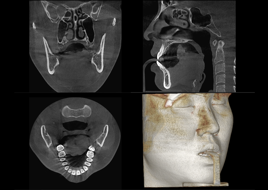 Genoray | Papaya 3D Premium/Ultra CBCT