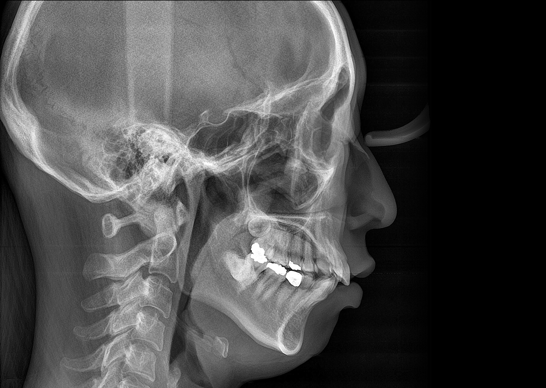 Genoray | Papaya 3D Premium/Ultra CBCT
