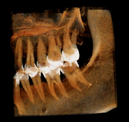 HDX WILL | Eco-X CBCT