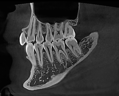 HDX WILL | Dentri MAX CBCT